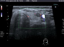 Ultrazvuk štitnjače ADF, čvor u lijevom režnju, klikni za povećanje Ultrazvuk štitnjače ADF, čvor u lijevom režnju, klikni za povećanje