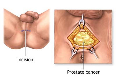 Prostatitis napon