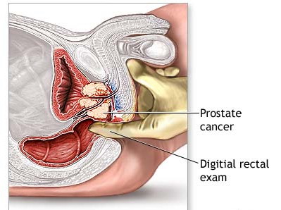 Digitorektalni pregled Ca prostate
