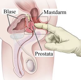 Prostatitis az idegen