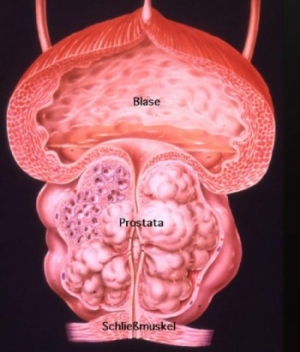 prostata simptome la barbati