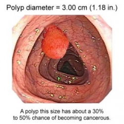 Dobroćudni tumori debelog crijeva, polipi