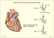 Dijastolička disfunkcija srca - 2. dio - Zdravo budi