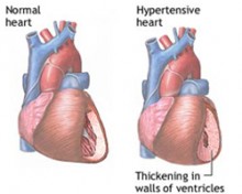 što je hipertenzija, srce