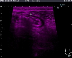 Upala slijepog crijeva-kolor dopler ultrazvuk