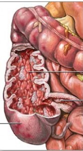 Upalna bolest crijeva - PLIVAzdravlje