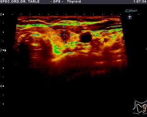 Ultrazvuk štitnjače-rak štitnjače