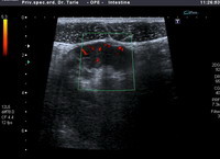 Ultrazvuk Chronova bolest,klikni za povećanje