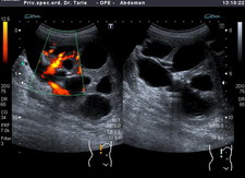 Ultrazvučna slika hidronefroze bubrega, nastala zbog vezikoureteralnog refluksa