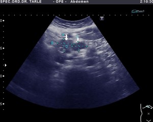 Ultrazvuk limfnih čvorova u abdomenu