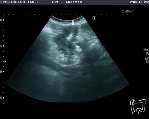 Ultrazvuk abdomena-ultrazvuka raka debelog crijeva