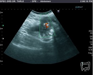 Ultrazvuk abdomena- ultrazvuka raka debelog crijeva 2