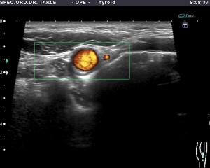 Ultrazvuk karotida