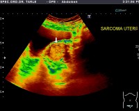Ultrazvuk abdomena-ultrazvuk materenice-sarkom