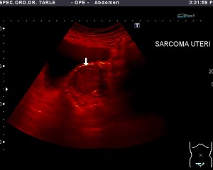 Ultrazvuk abdomena-ultrazvuk maternice-sarkom
