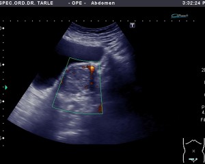 Ultrazvuk maternice-ultrazvuk maternice-sarkom 2