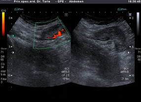 Rak debelog crijeva-ultrazvuk, klikni za povećanje