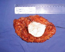 Operacija dojke s tumorom