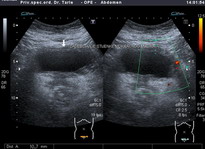 Ultrazvučna slika upale mokraćnog mjehura, klikni za povećanje