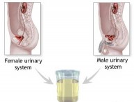 Uzimanje uzorka urina za urinokulturu i ABG