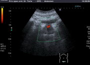 Ultrazvučna slika uvećane prostate 