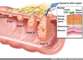 Stadiji raka debelog crijeva