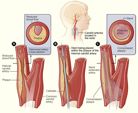 ateroskleroze karotidnih arterija na vratu