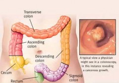 Simptomi raka debelog crijeva