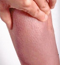 Dermatitis potkoljenice kod Gravesove bolesti