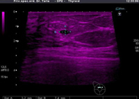 Slika prikazuje cistu u iste pacijentice ali prikazanu posebnim programom koji omogućava lakše uočavanje promjene
