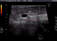 Prikaz iste pacijentice s cistom u dojci koja je prikazana  prethodnom panoramskom slikom dojke