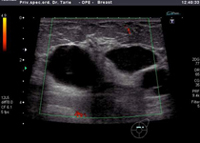 Ultrazvučna slika pokazuje dvije veće ciste u dojci, nema vidljivog krvnog protoka unutar 