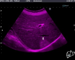 Ultrazvuk jetre-hemangiom