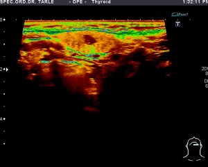 Ultrazvuk žlijezde slinovnice-tumor žlijezde slinovnice