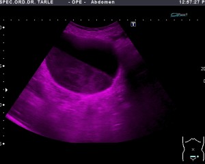 Ultrazvuk abdomena-ultrazvuk mokraćnog mjehura- upalni sadržaj u mjehuru