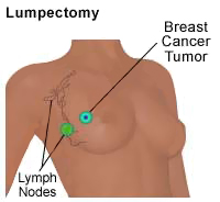 Rak dojke i presadnica (metastaza) stanica raka u okolne limfne čvorove