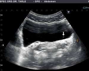 Ultrazvuk abdomena-ultrazvuk mokraćnog mjehura-kamenac
