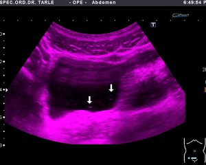 Ultrazvuk trbuha-ultrazvuk mokraćnog mjehura-kamenac