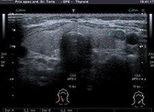 Ultrazvuk štitnjače, čvor u lijevom režnju, klikni za povećanje