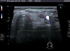 Ultrazvuk štitnjače ADF, čvor u lijevom režnju, klikni za povećanje