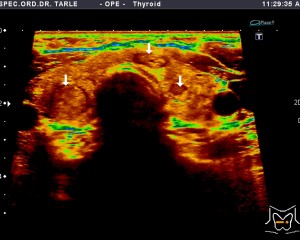 Ultrazvuk štitnjače-Hašimotov tiroiditis