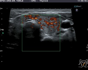 Ultrazvuk štitnjače-Hašimotov tiroiditis